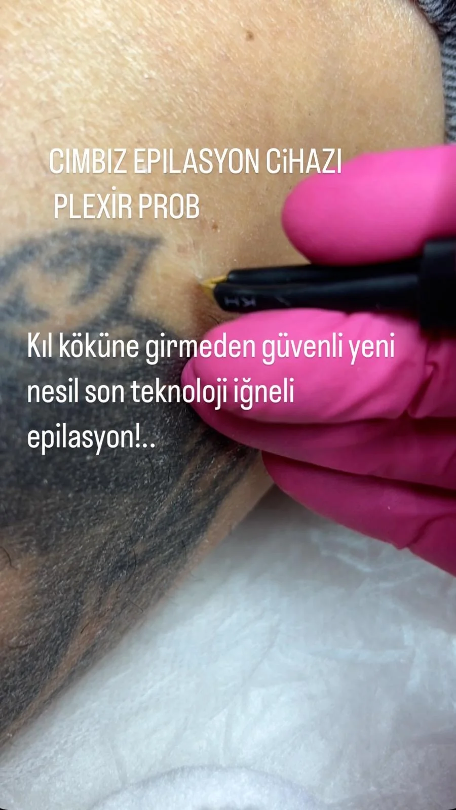 Pendik Cımbız Epilasyon - Görsel 4